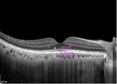 The Relationship Between Choroidal and Photoreceptor Layer Thickness With Visual Acuity in Highly Myopic Eyes